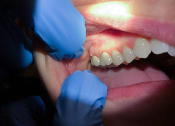 Best Emergency Care for Gum Disease in Ithaca, MI